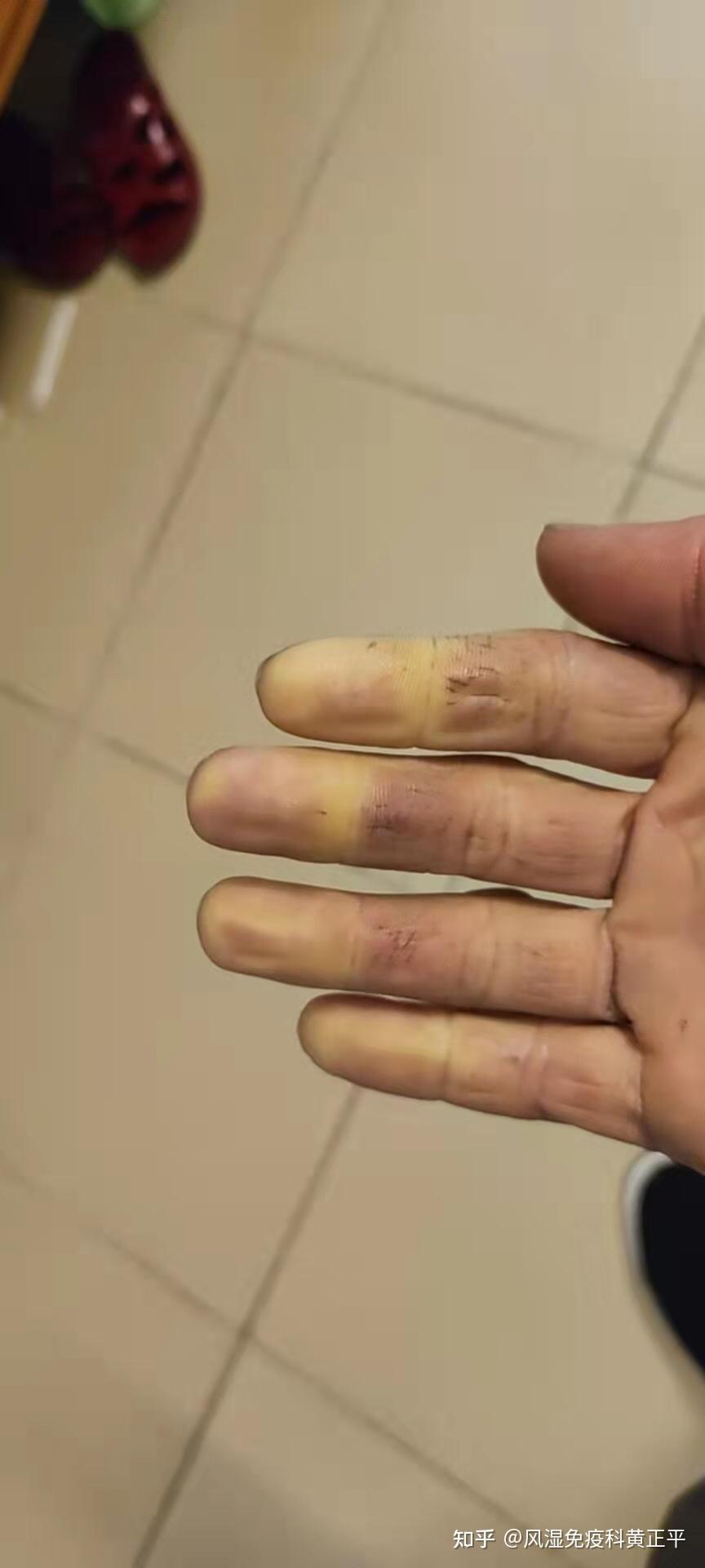 天气变冷手指变白变紫小心雷诺现象