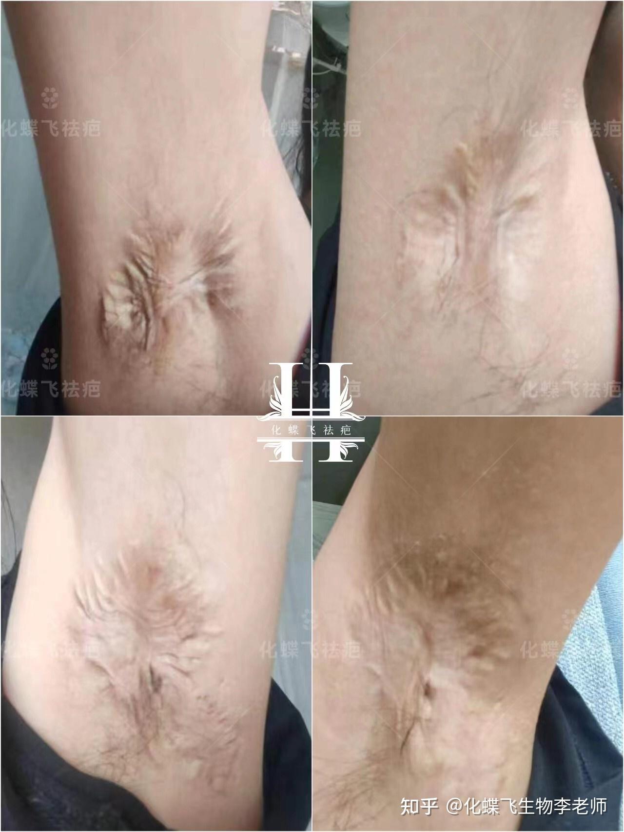 狐臭手术后留疤,你还敢做吗?