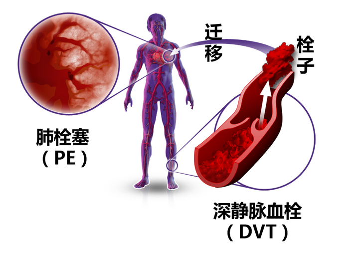 静脉血栓栓塞症-风险评估 - 知乎