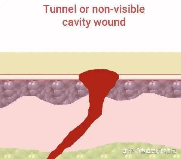 窦性指的是什么意思