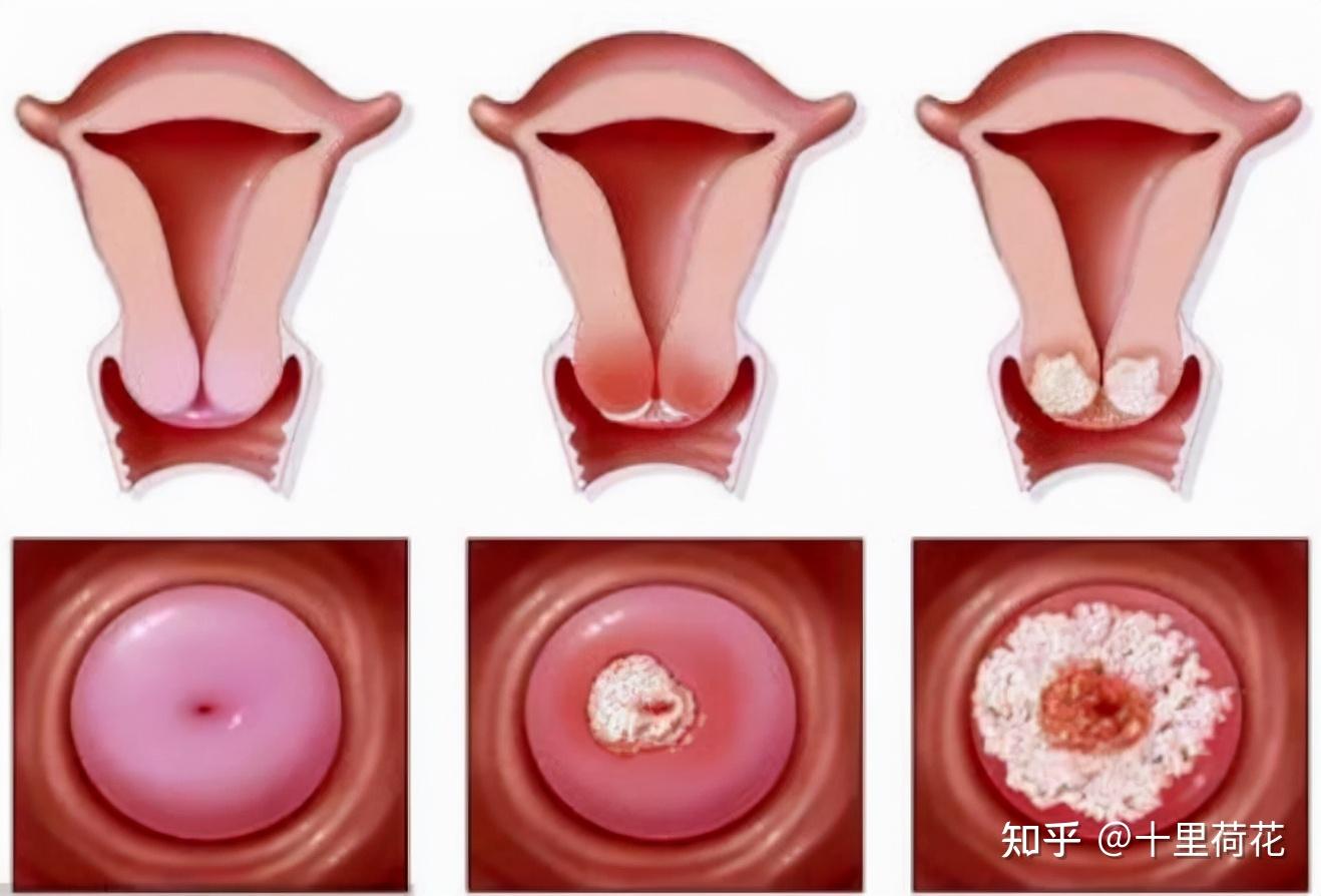 女子月经不调1月后查出宫颈二级病变医生2个情况早该重视