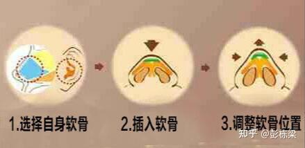 隆鼻用耳软骨取出后耳朵会变形吗? - 知乎