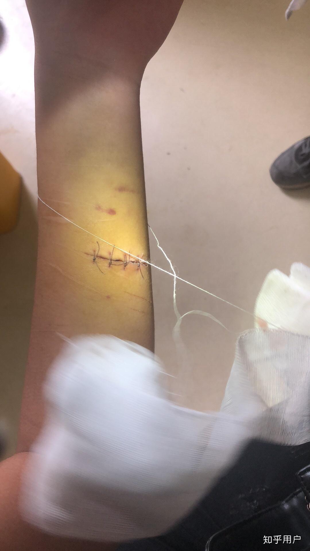 抑郁症究竟有多可怕?