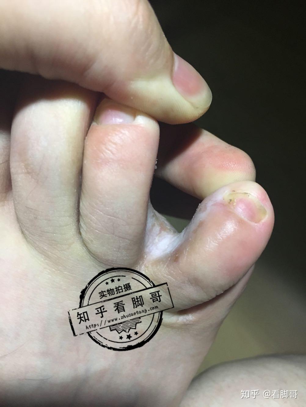 白色念珠菌,侵删我们来看一下经常遇到的烂脚丫,通常是白色念珠菌感染
