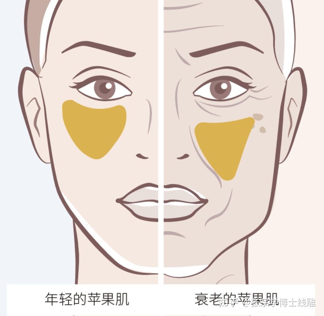 苹果肌下垂凹陷怎么办?