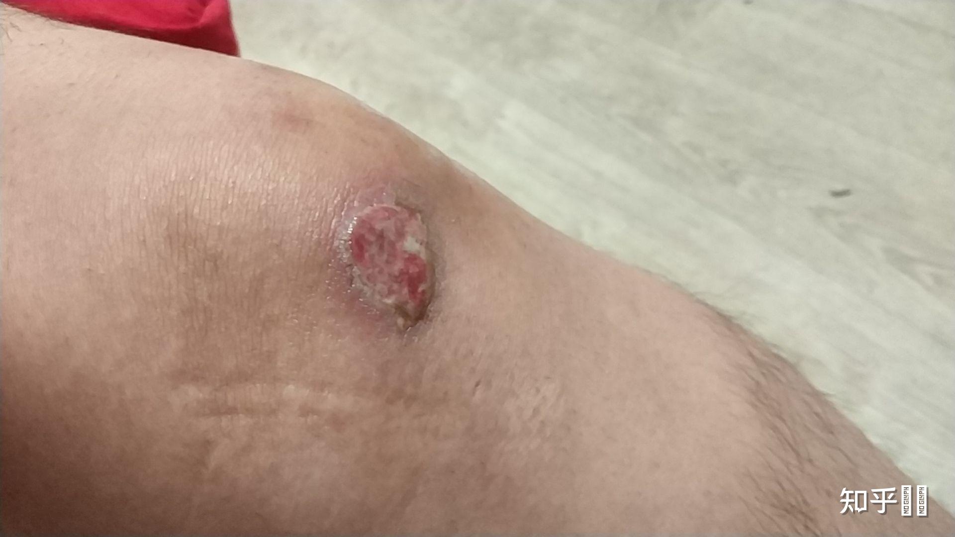 膝盖摔伤破了一大块皮流水抹云南白药好了一点三天后开始流水了咋办呢
