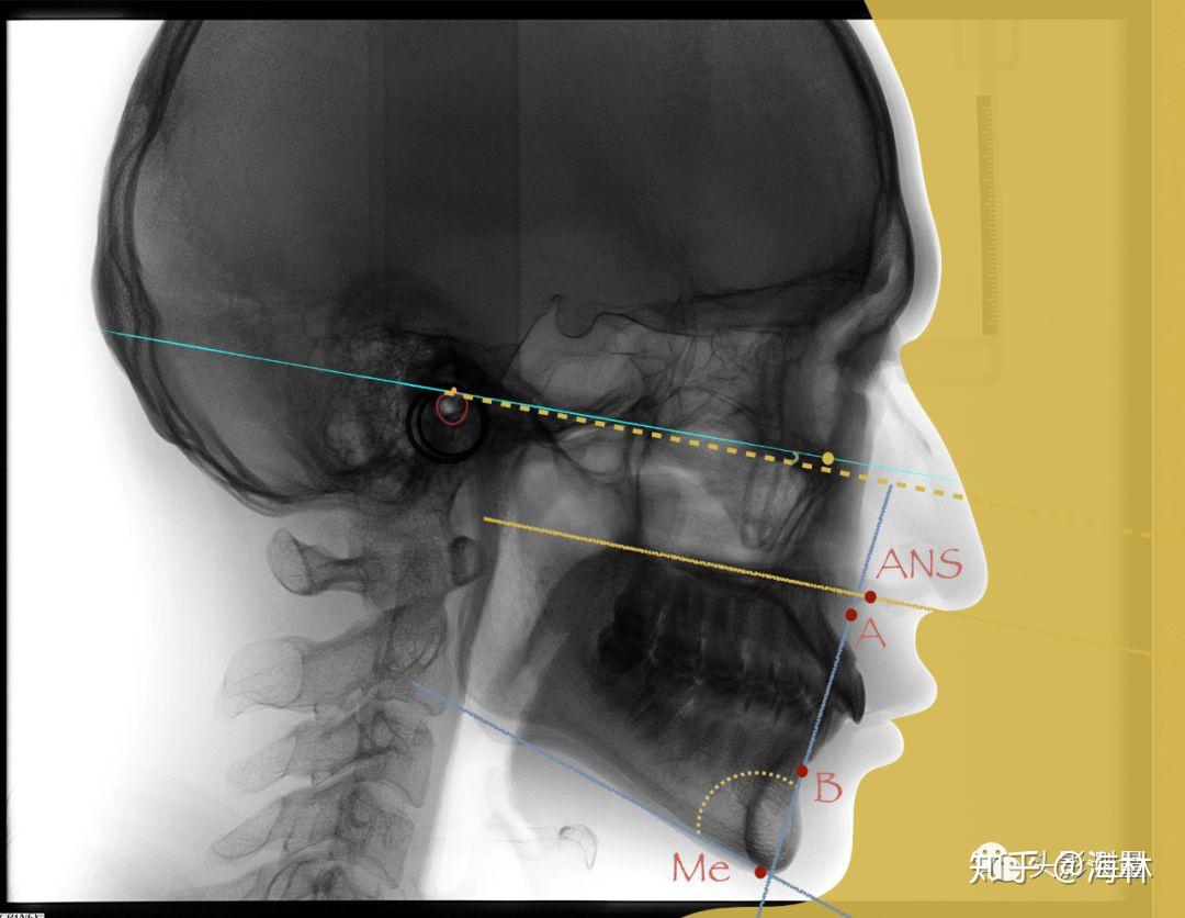 关于高角低角,看这一篇就够了----头影测量