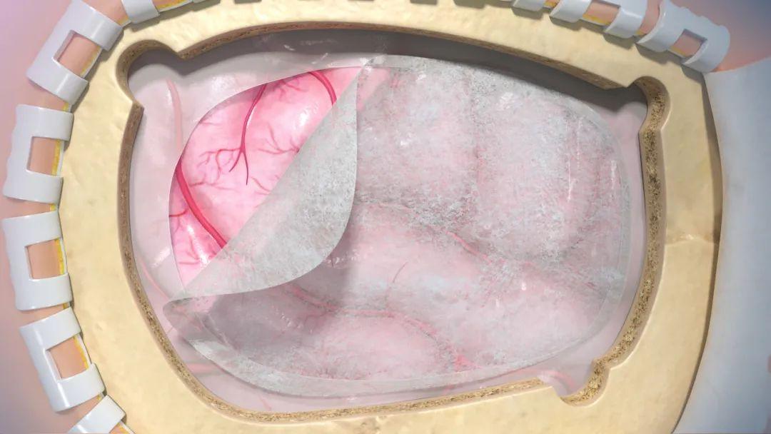 国械注准20213130157国内首个非交联细胞外基质源的硬脑膜产品硬脑膜