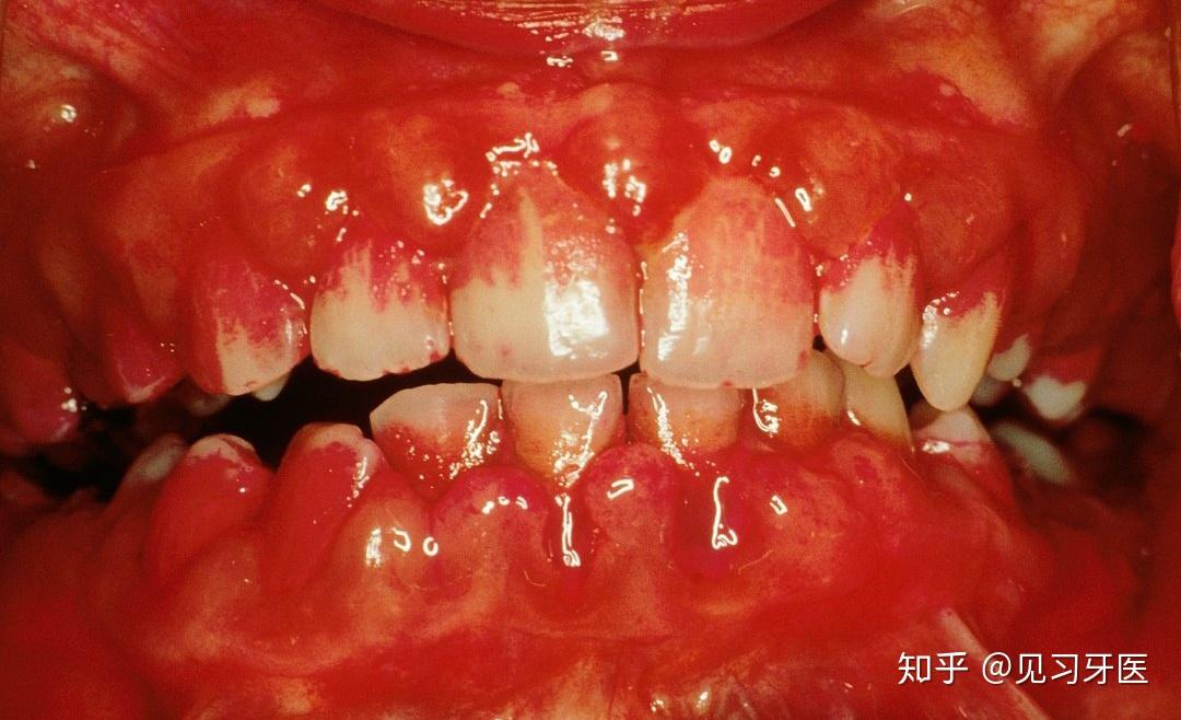 牙周炎,牙周病中一种更糟糕的形式,因为它可以破坏支持牙齿的软组织和