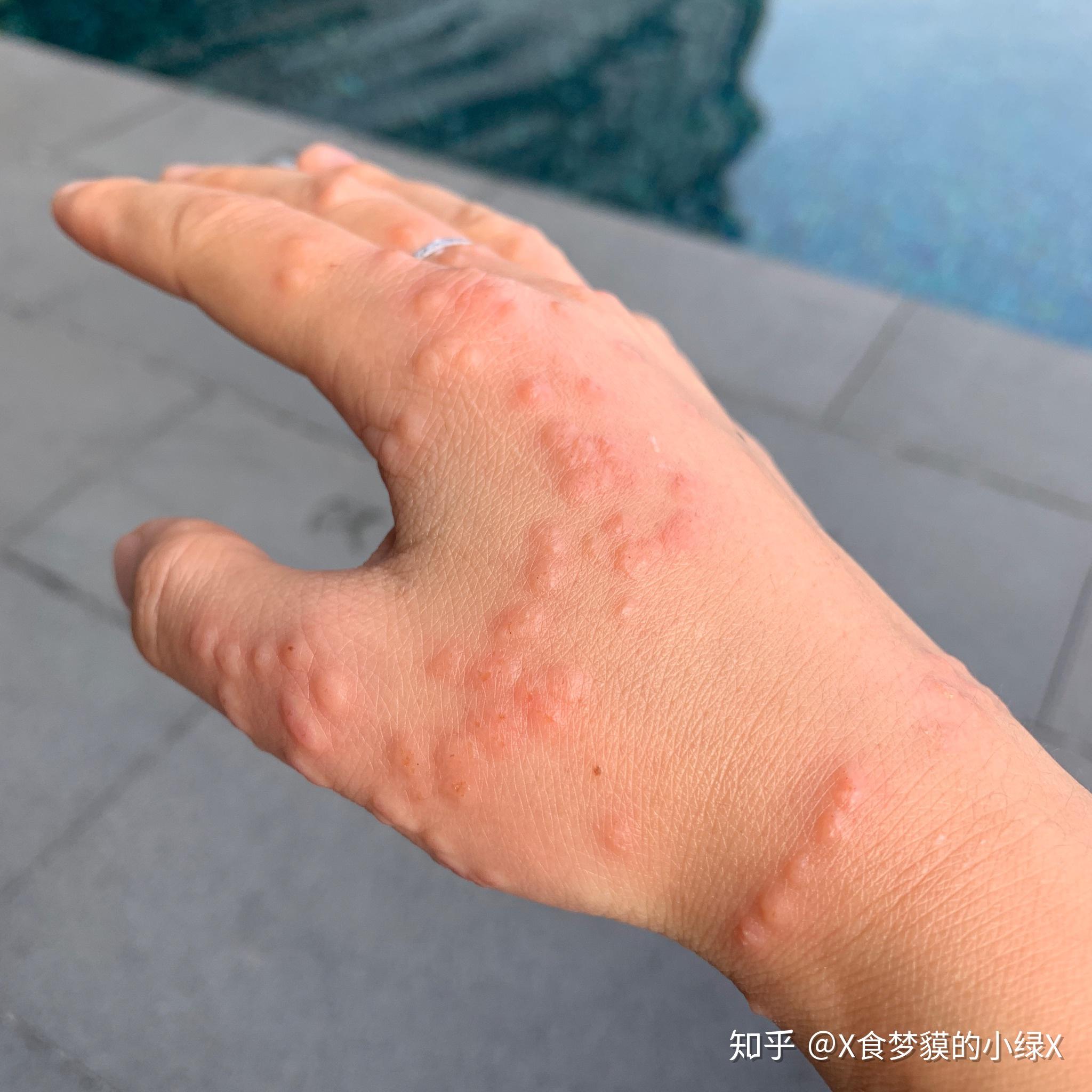 被水母蛰是一种什么体验? - 知乎