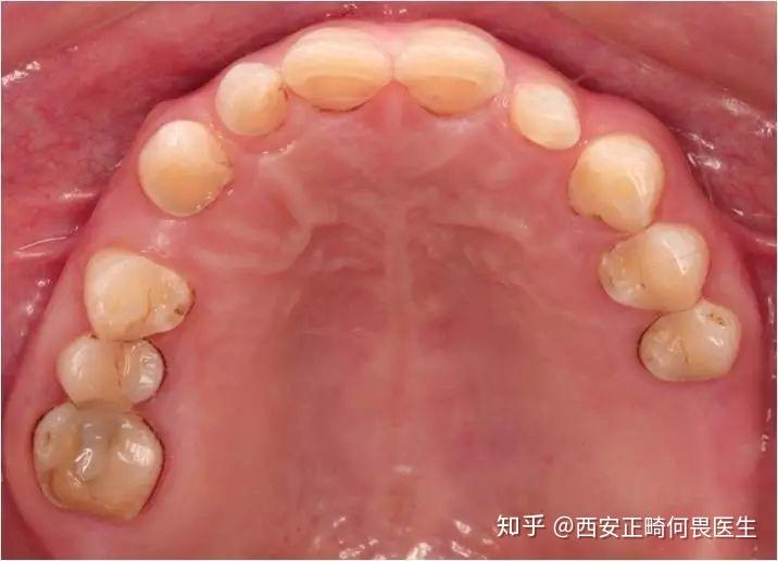 西安牙齿矫正:『以dsd美学设计为导向』牙列重度磨耗患者全口咬合重建