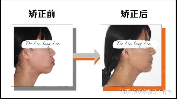 牙齿开合，嘴唇闭不上，戴牙套能矫正吗？ - 知乎