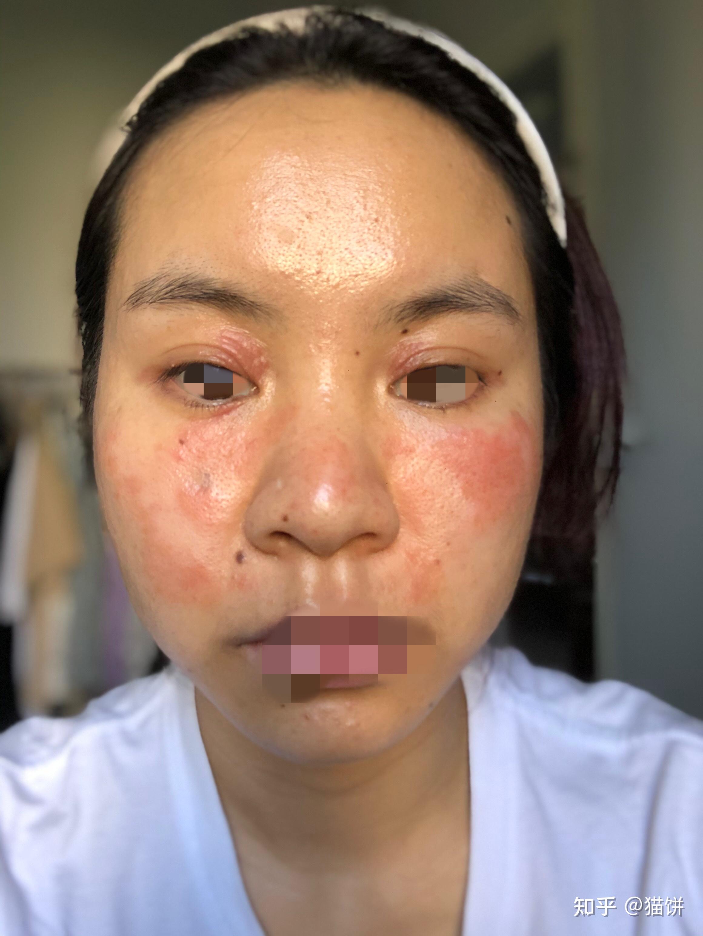 过敏7年的经历,从脂溢性皮炎到激素依赖性皮炎到过敏性鼻炎 过敏性皮