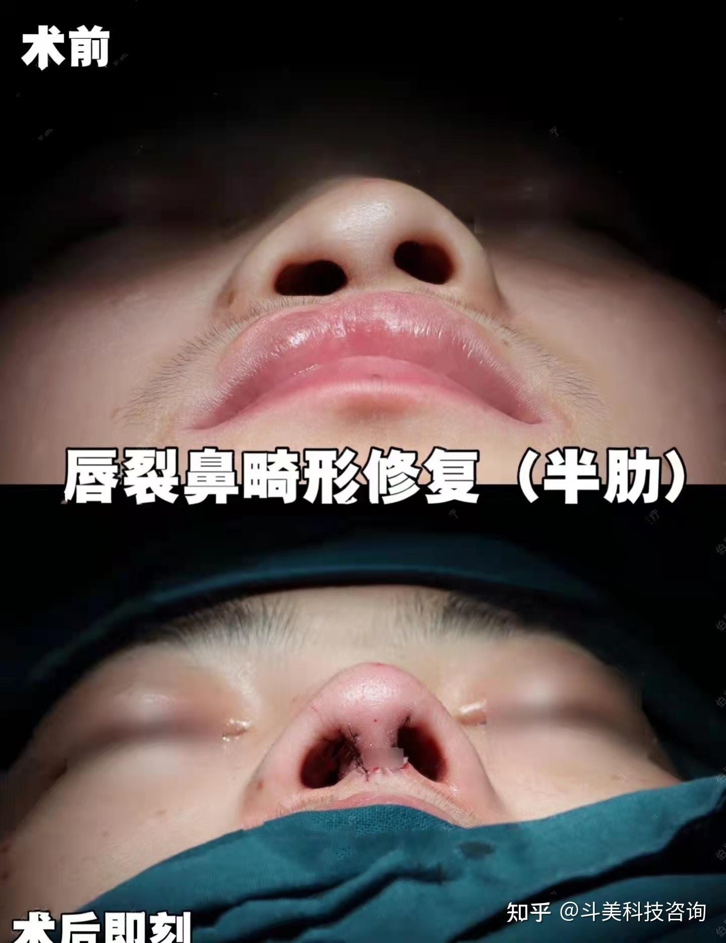 南京有哪些做唇腭裂修复的医院? - 知乎