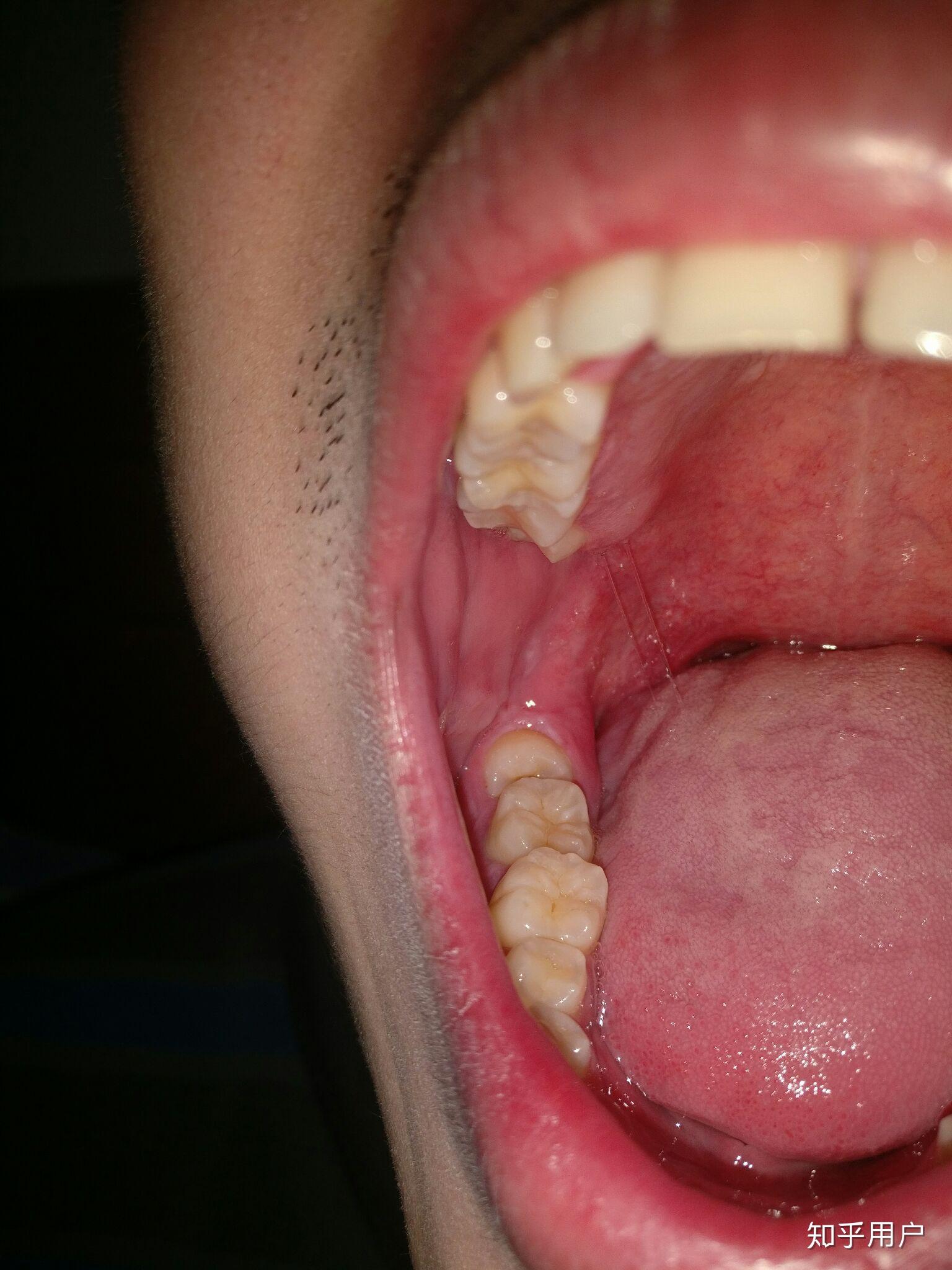 牙齿松动了怎么办