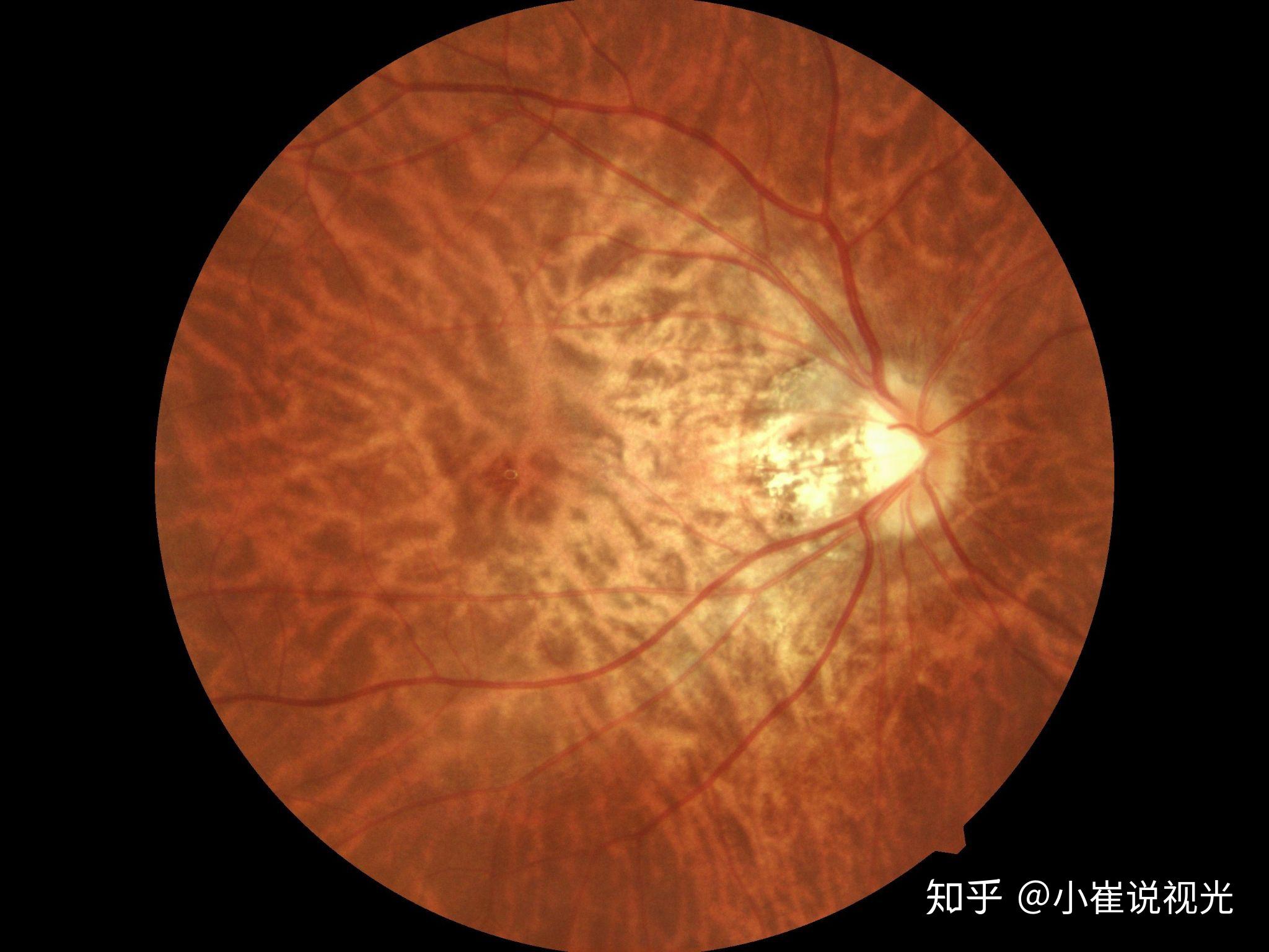 视网膜色素上皮脱离-临床眼科-医学