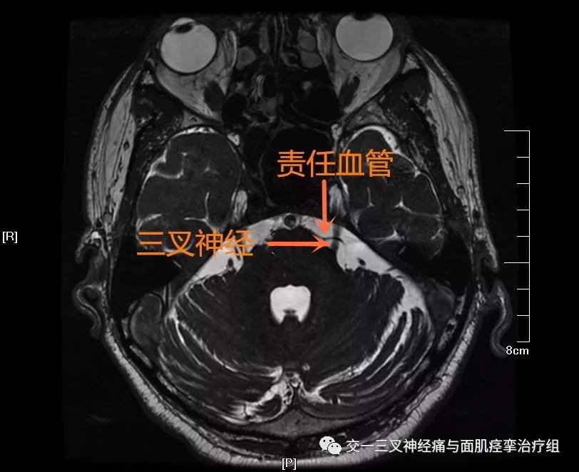 三叉神经痛 面肌痉挛手术前的主要影像学检查 知乎