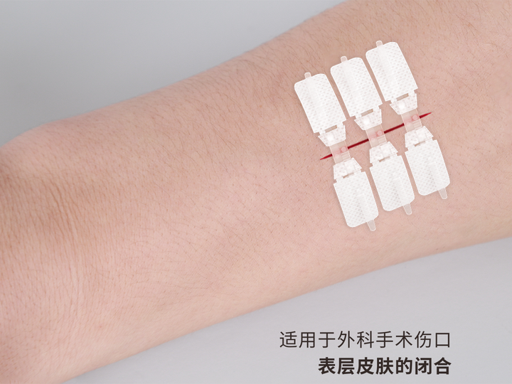 医用缝合拉扣怎么拆除？医用缝合拉扣的使用方法-亚都医疗 - 知乎