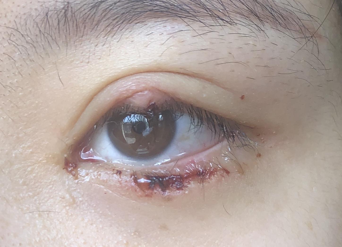 有没有得过外麦粒肿的朋友,怎么个痊愈过程? - 知乎