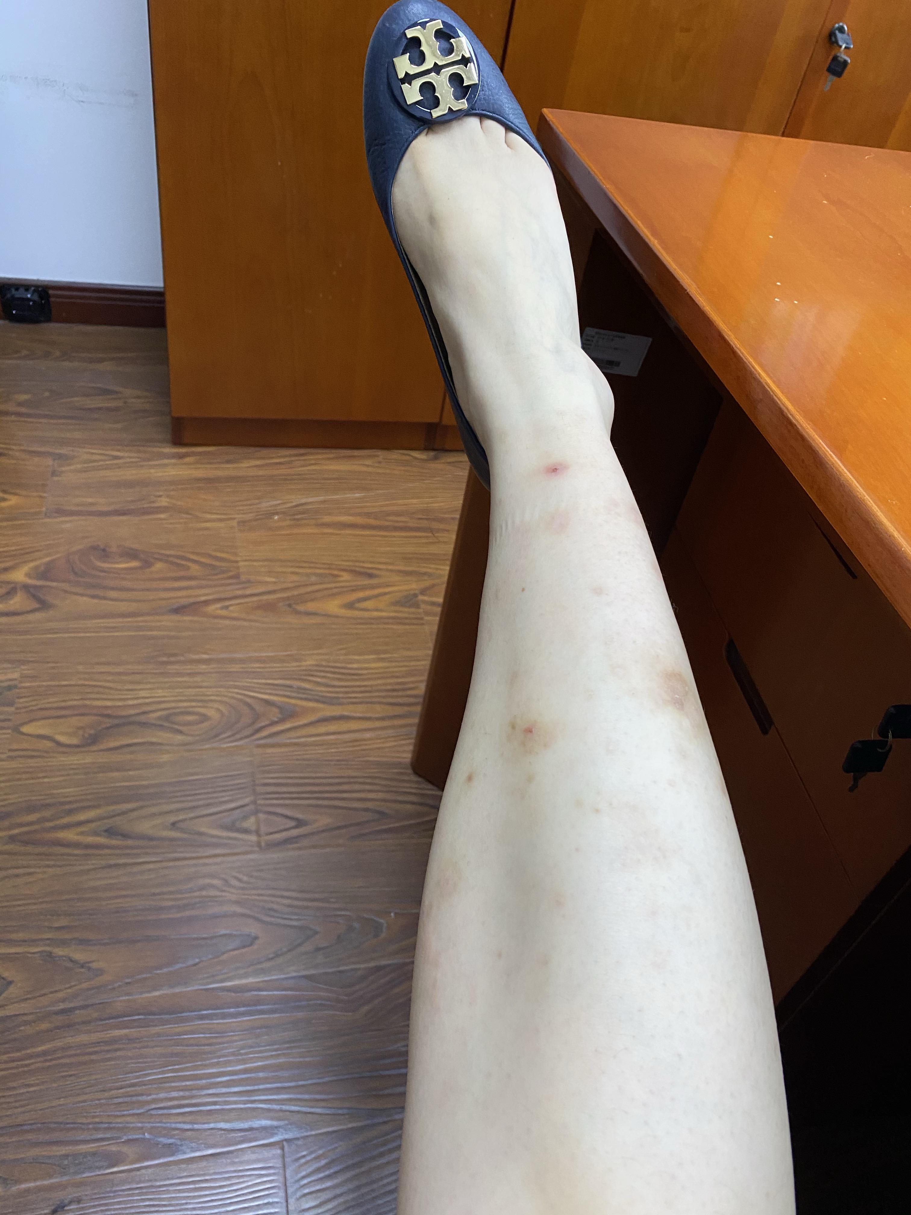 我是女生腿上手上都有难看的疤痕从小到大蚊子一咬就留疤基本不敢穿超