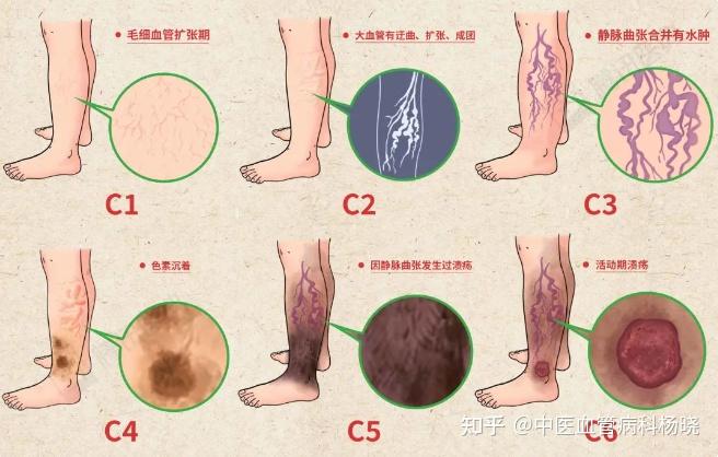 下肢静脉曲张有哪些早期信号吗? - 知乎