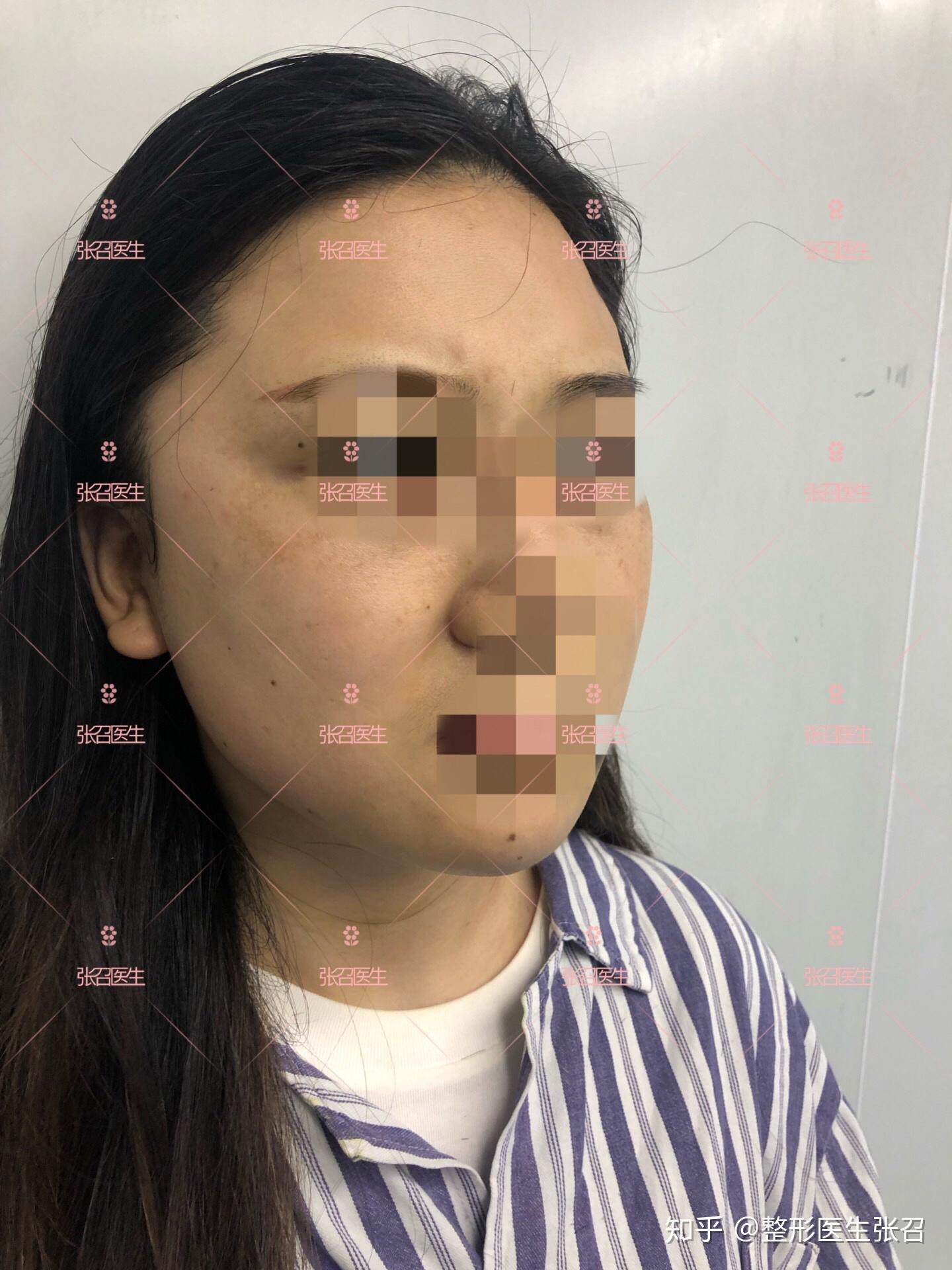 太阳**凹陷填充花多少钱_填充太阳凹会不会显脸大_填充太阳凹后悔