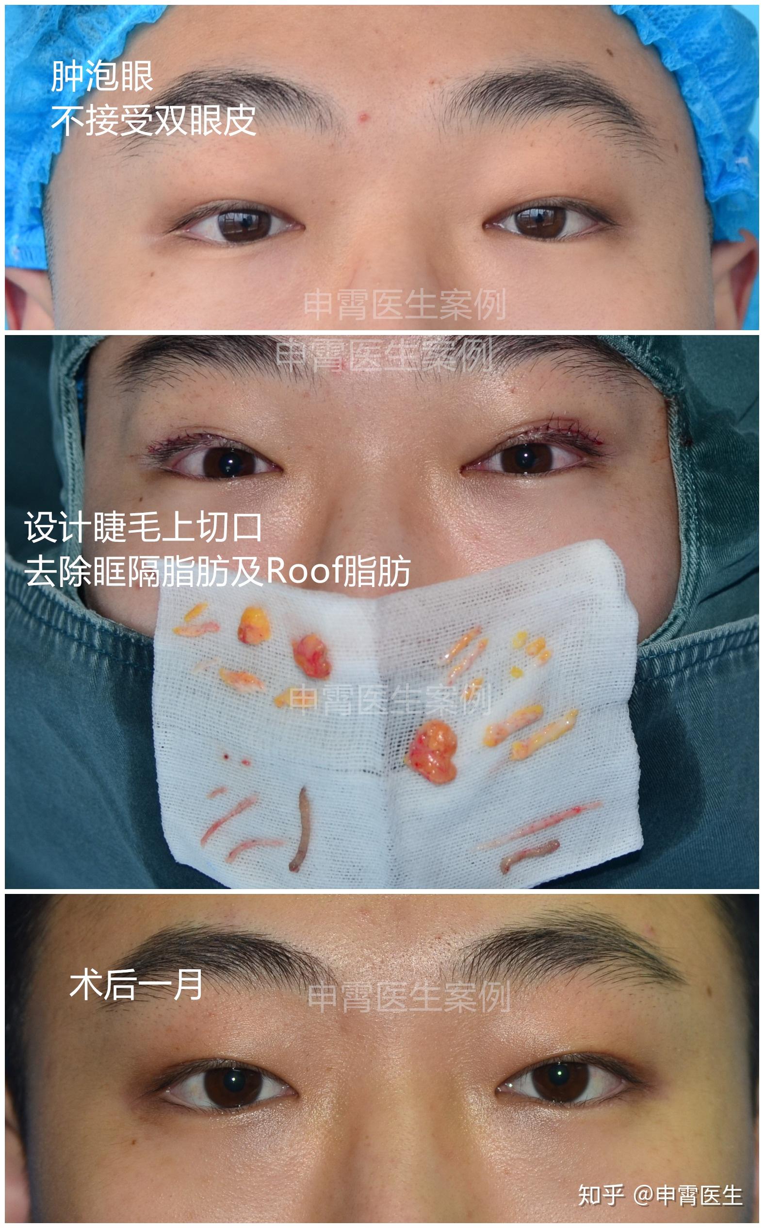 上眼睑松弛（去皮去脂）+外切去眼袋框格释放（去皮去脂）双眼皮+眼袋手术 - 知乎