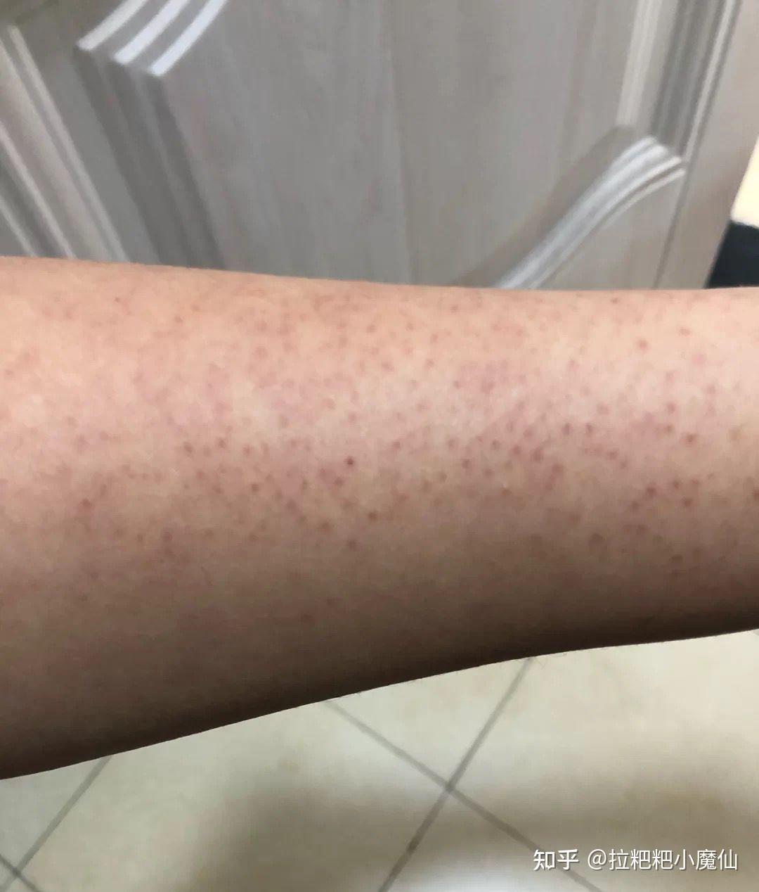 有鸡皮肤是什么体验