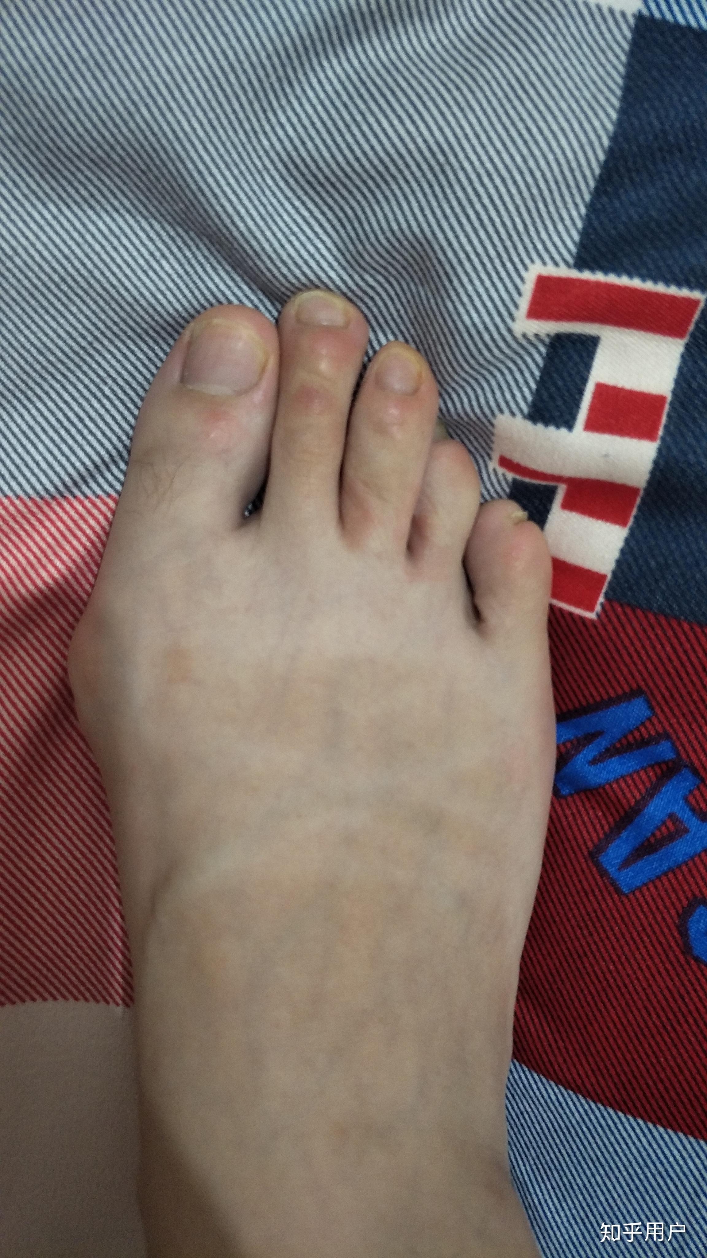 为什么有些人的第二个脚趾头比第一个长