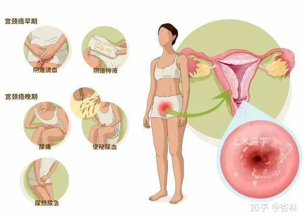 子宫癌的早期症状图片图片