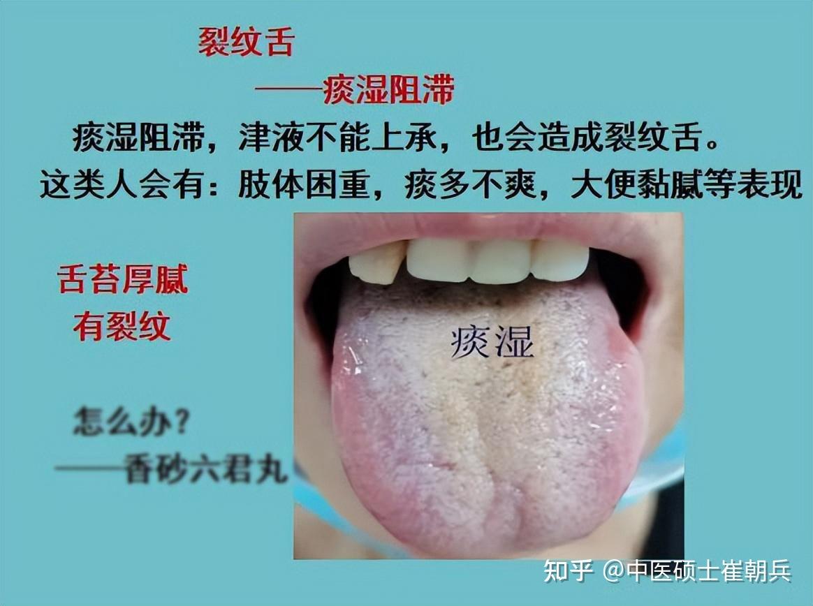 舌头有裂纹?5种原因,9种舌象,看看你是属于哪一种? - 知乎