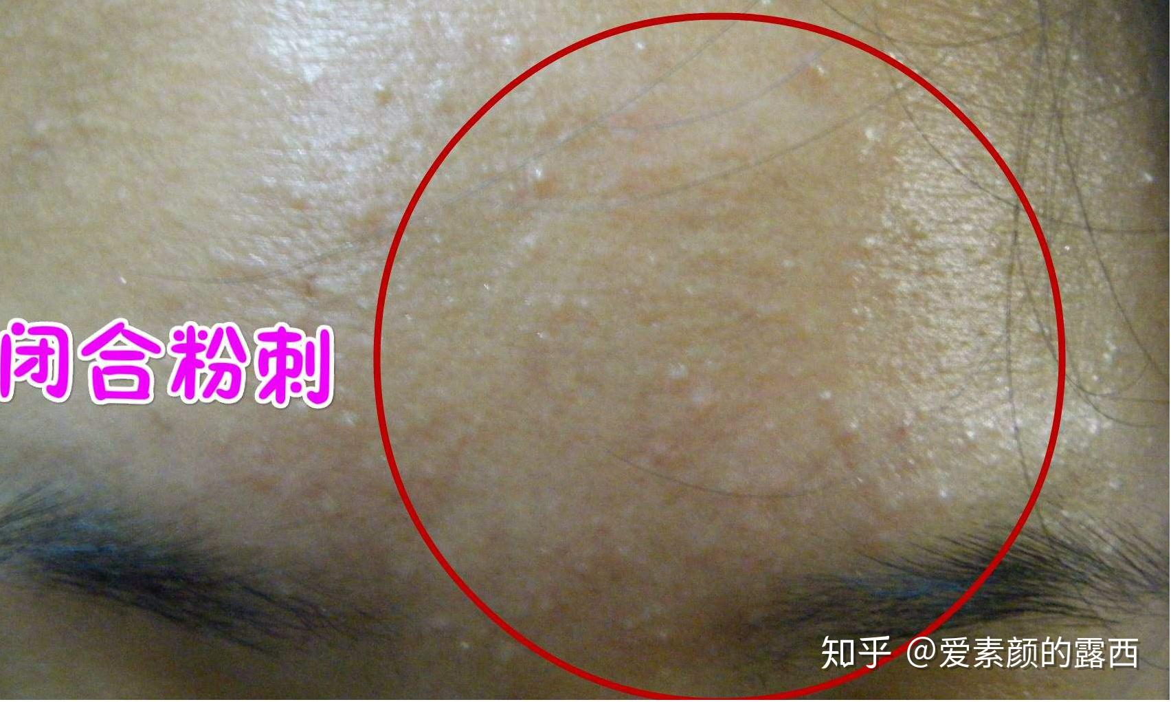脸上都是闭口和粉刺怎么办? - 知乎