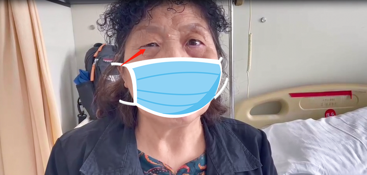 疑问医答:面肌痉挛患者应该在什么情况下需要手术治疗 - 知乎