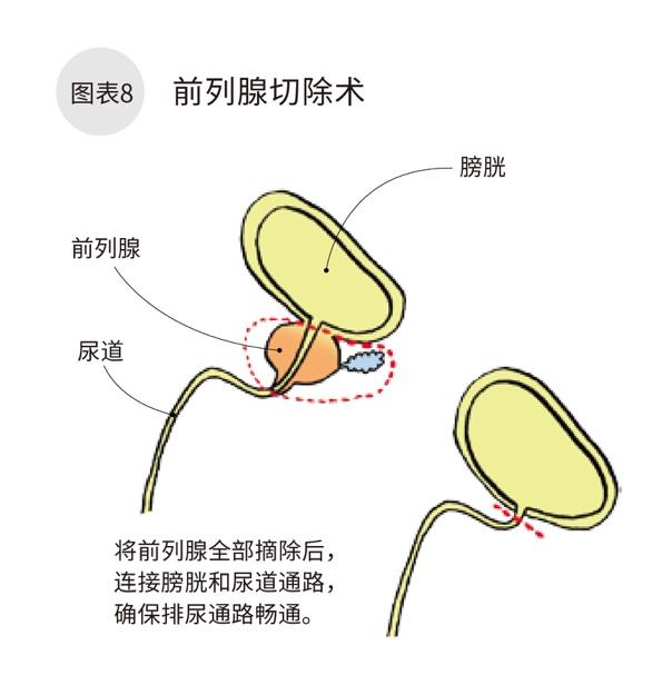 前列腺增生手术示意图图片