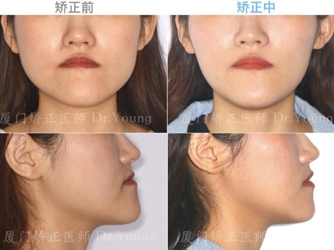 牙齿地包天矫正后会对脸型和唇形有改变吗? - 知乎
