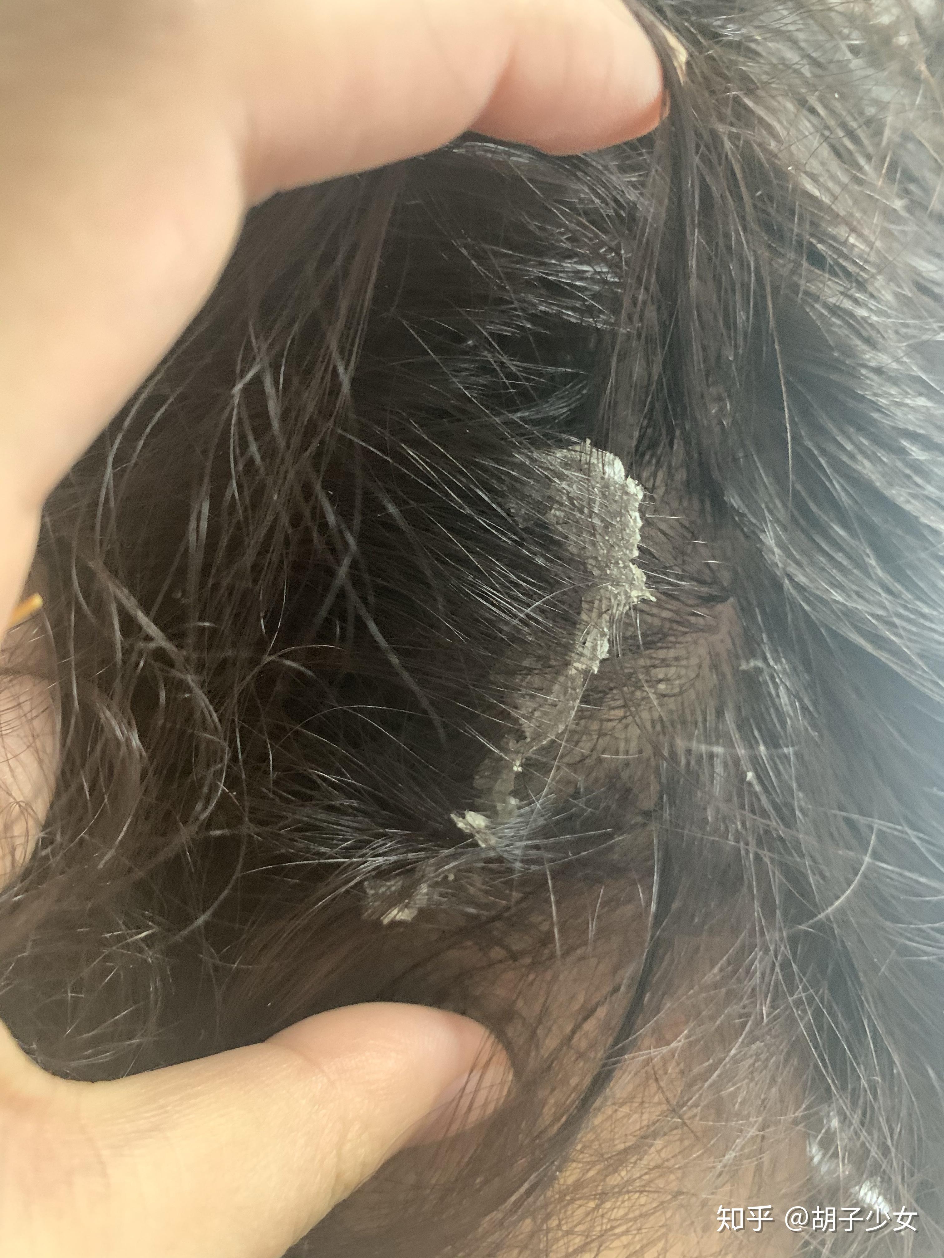 见过的最大头皮屑多大