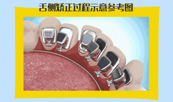 明星都做的舌侧矫正,有什么优点?