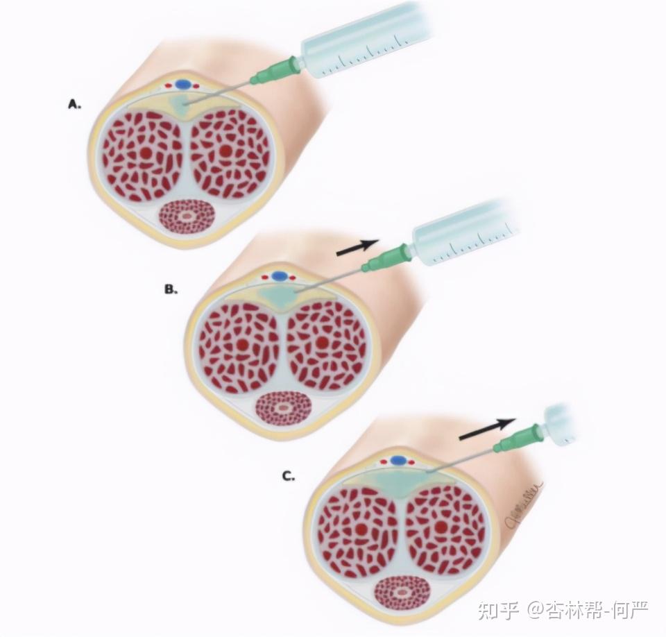 男科假体植入术图片