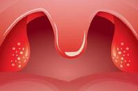 首大崔付军:急性化脓性扁桃体炎治疗要及时