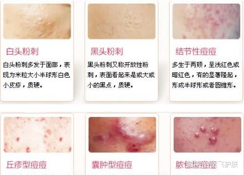 痘痘的几种分类