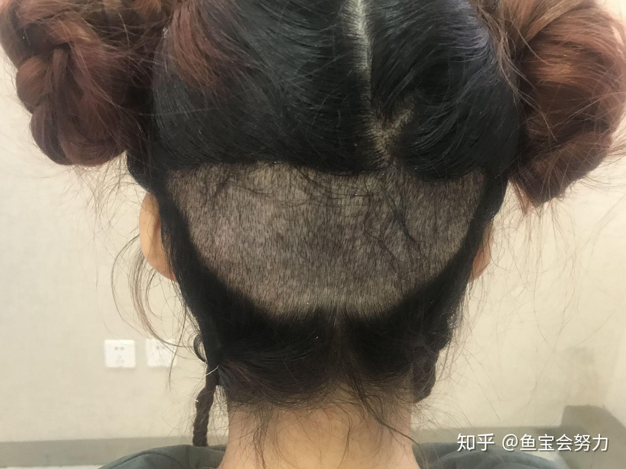 植发取发实拍(植发取法部位疼几天)