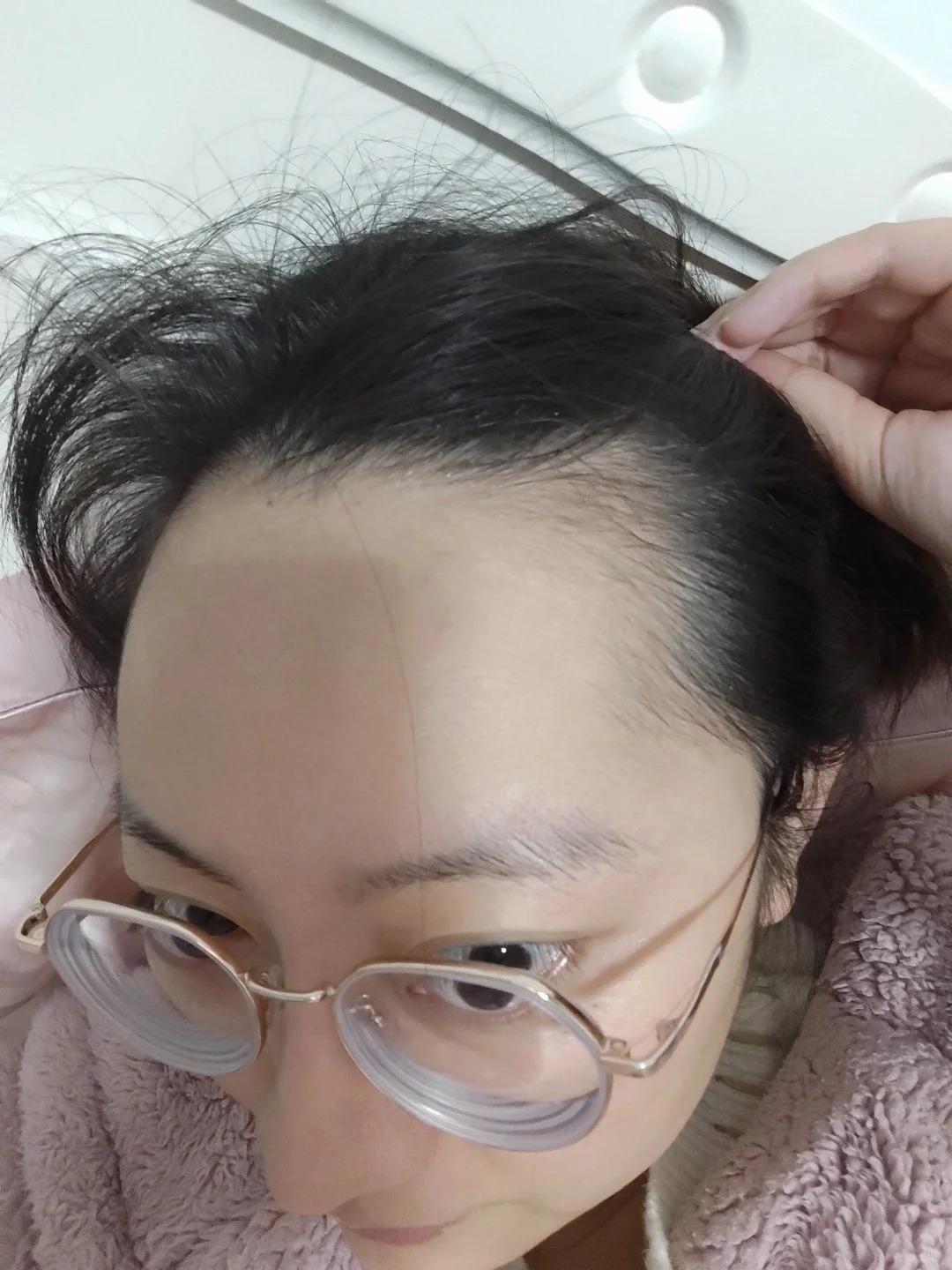 女生脱发严重是种怎样的体验?