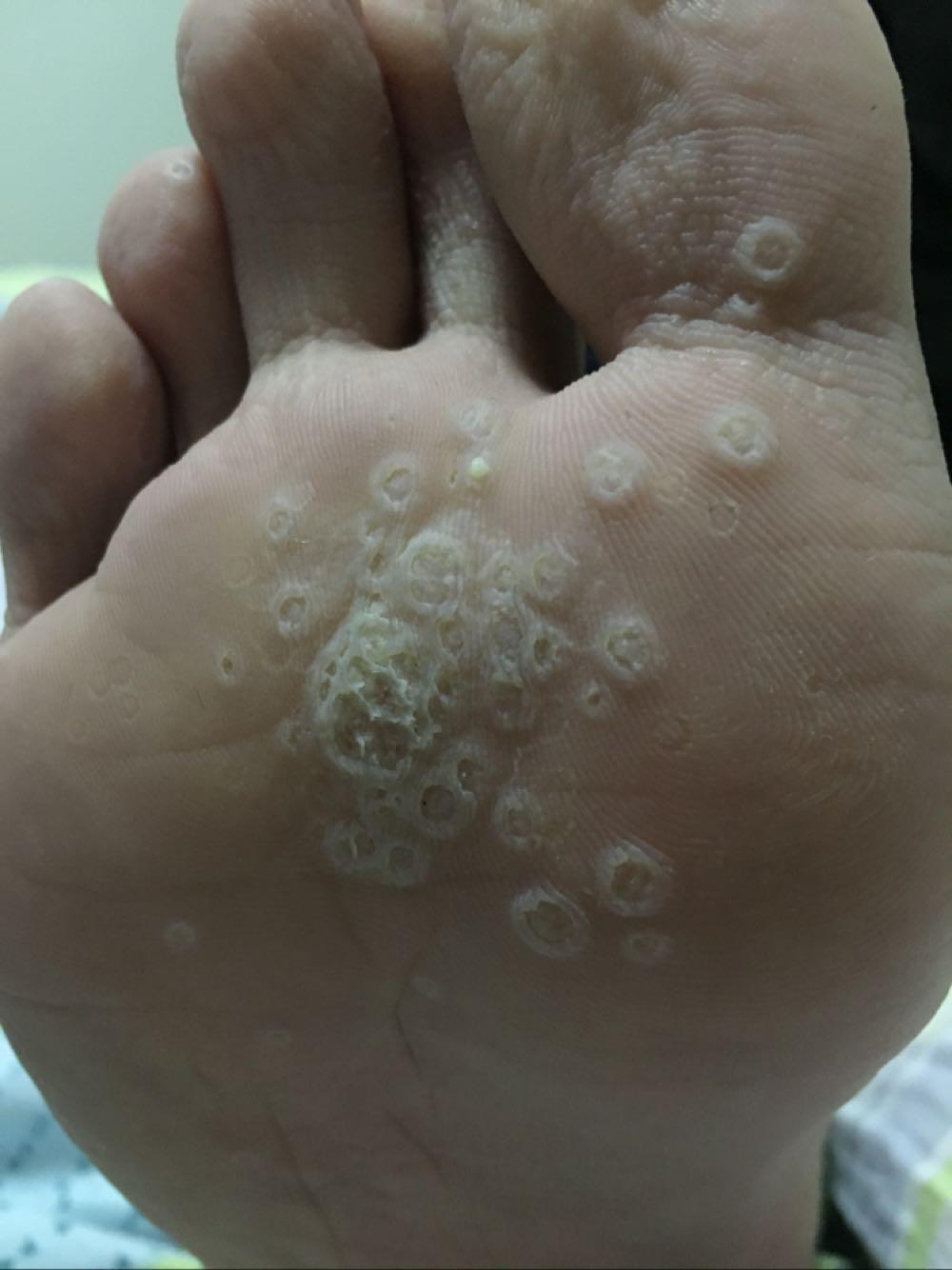 脚上长了跖疣怎么办