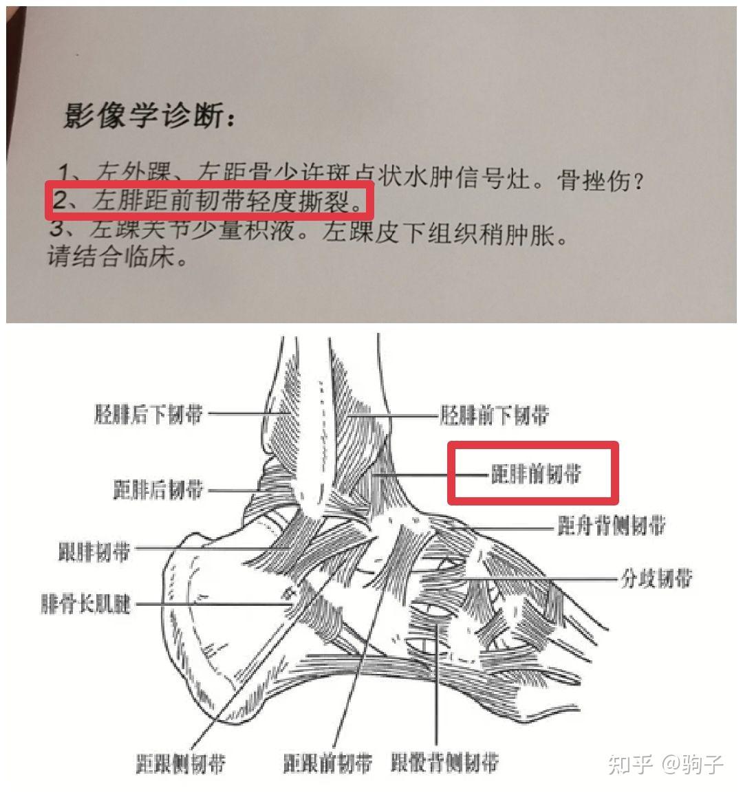 左脚踝关节扭伤,距腓前韧带撕裂2级,手术两颗铆钉修复? - 知乎