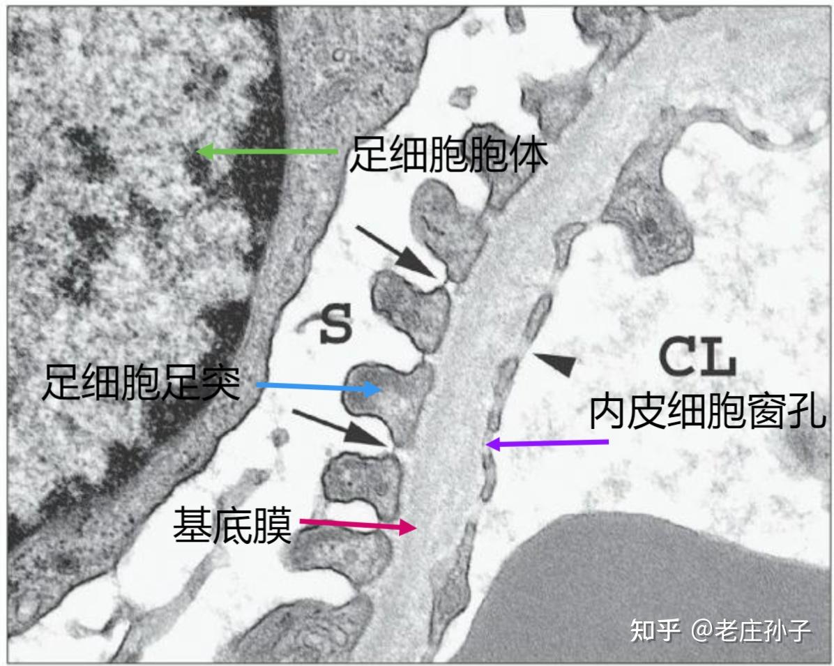 出现蛋白尿,除了是肾脏病,还有可能是什么?