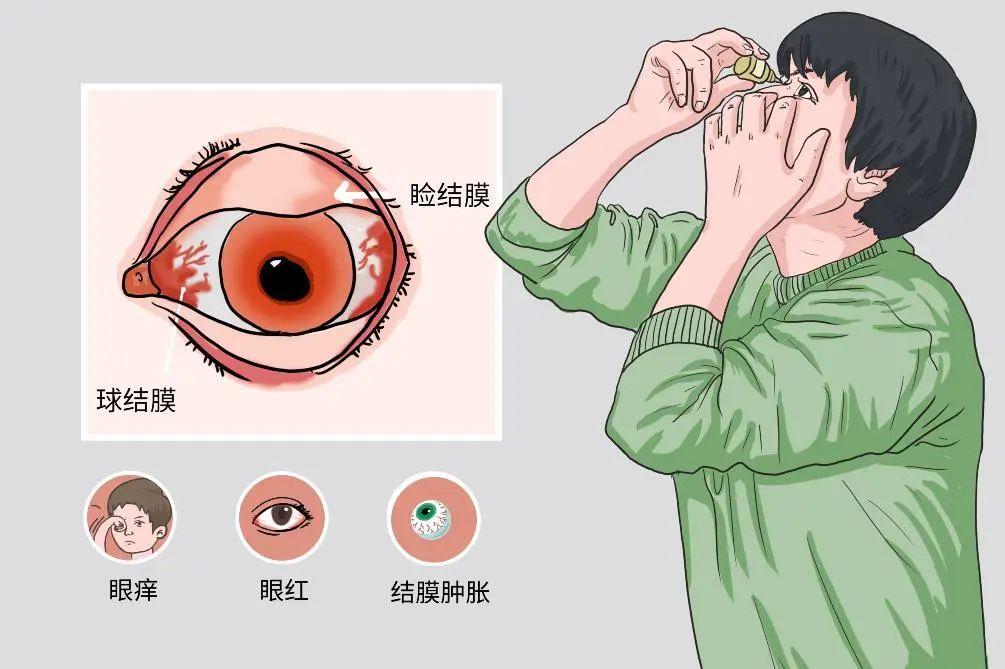 科普 | 眼屎突然变多?可能是眼睛生病了~ - 知乎