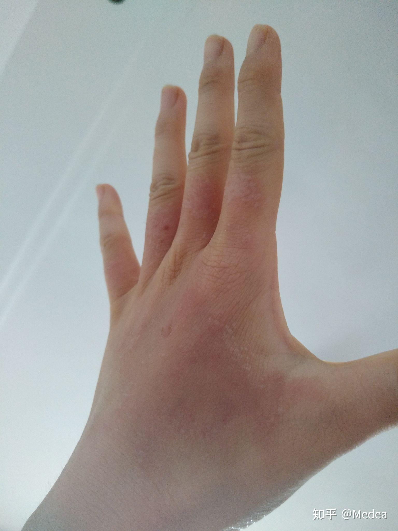 手被开水烫伤了怎么办