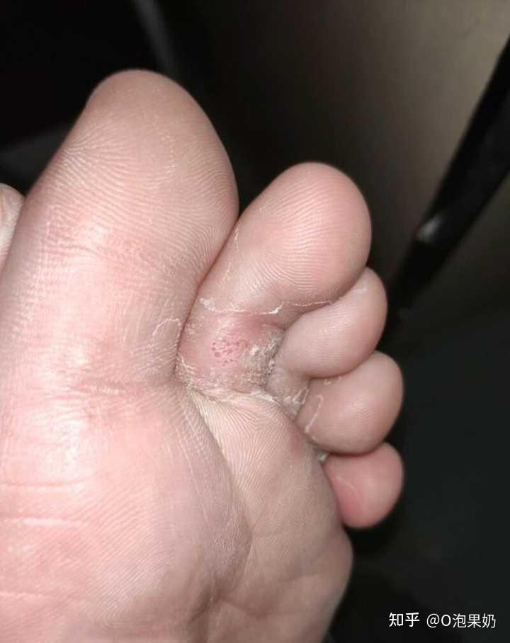 怎么治疗脚气 - 知乎