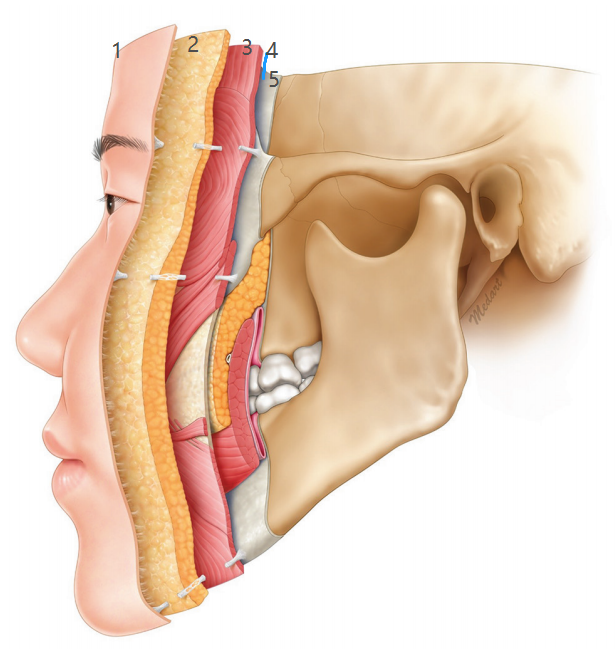 層次:1皮膚層,2皮下淺筋膜脂肪層,3淺表肌肉系統smas,4間隙層,5骨膜層