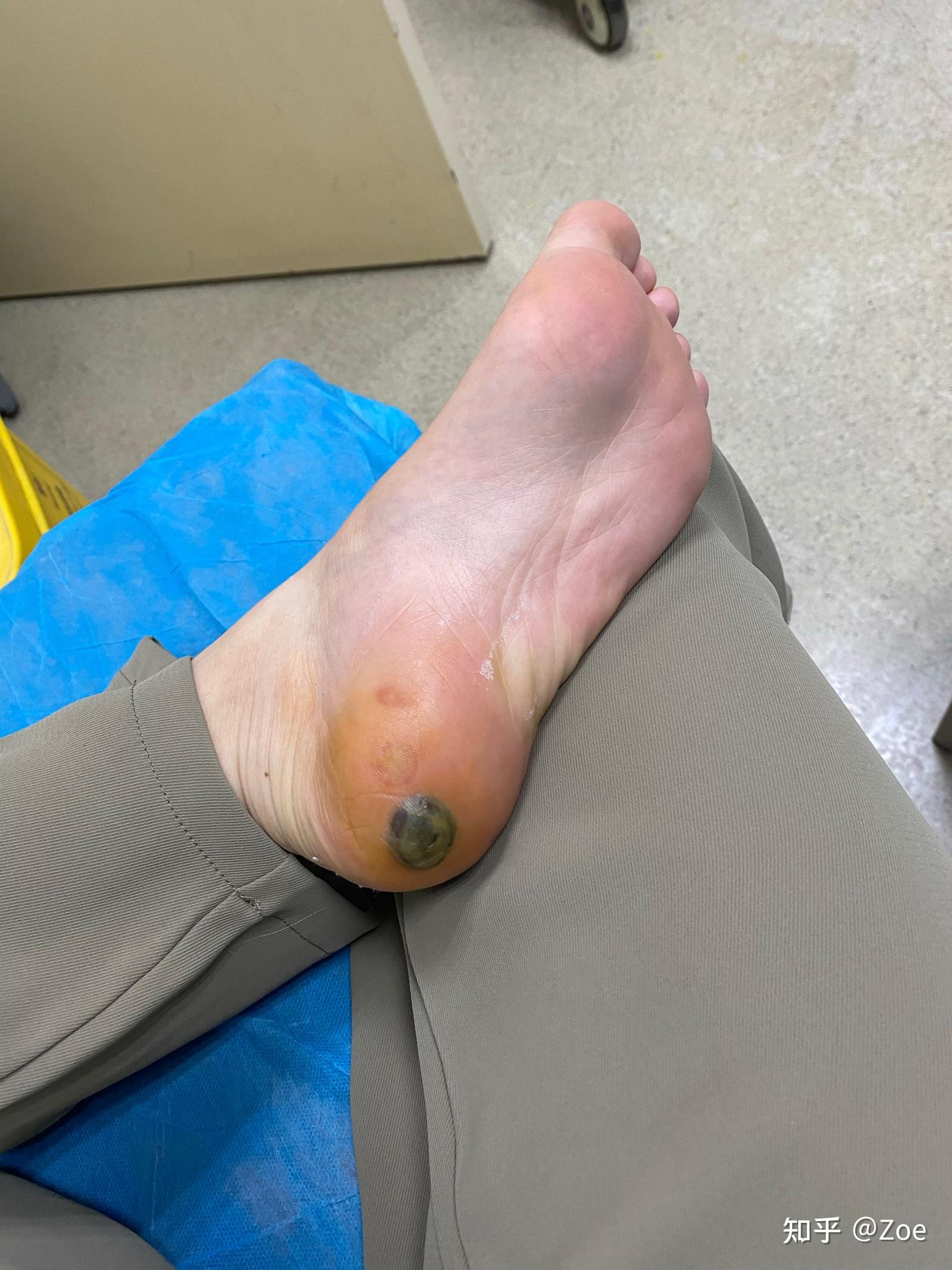 但是取出血果然好了很多,不动的话脚不会感到很疼了.